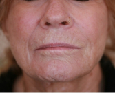 Feel Beautiful - Lip Wrinkles Smoothing - Before Photo